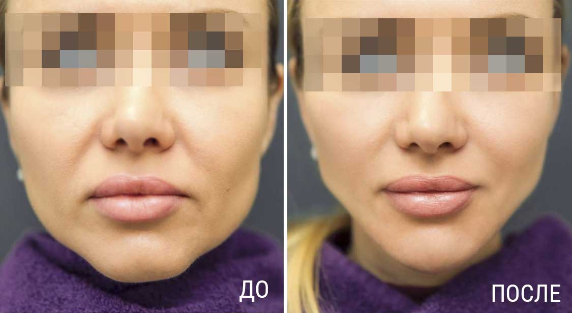 омоложению лица FullFace