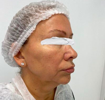 Лазерное омоложение кожи I Удаление морщин лазером цена в клинике Алтеро