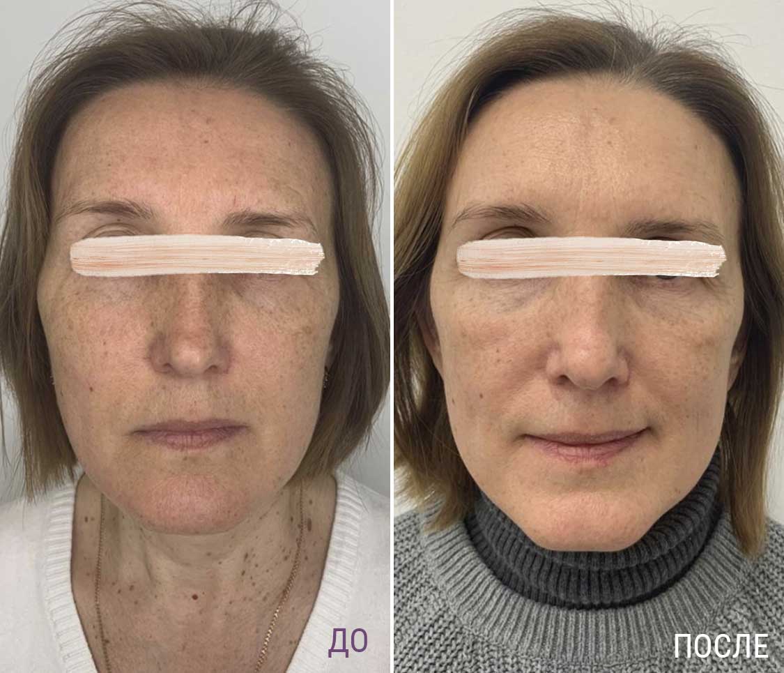 Метод FullFace фото